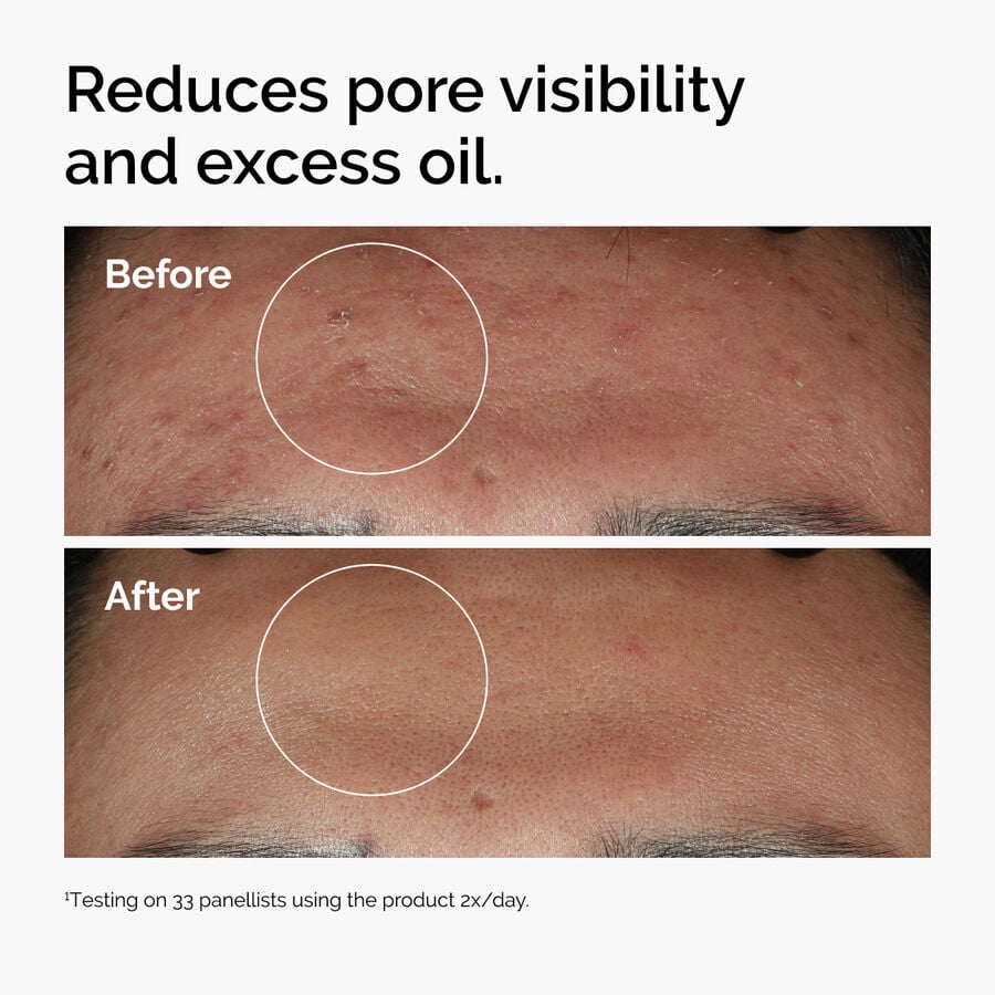 niacinamide-10-zinc-1-e6 ord-niacinamide-zinc-blemish-serum-before-after-pores.jpg