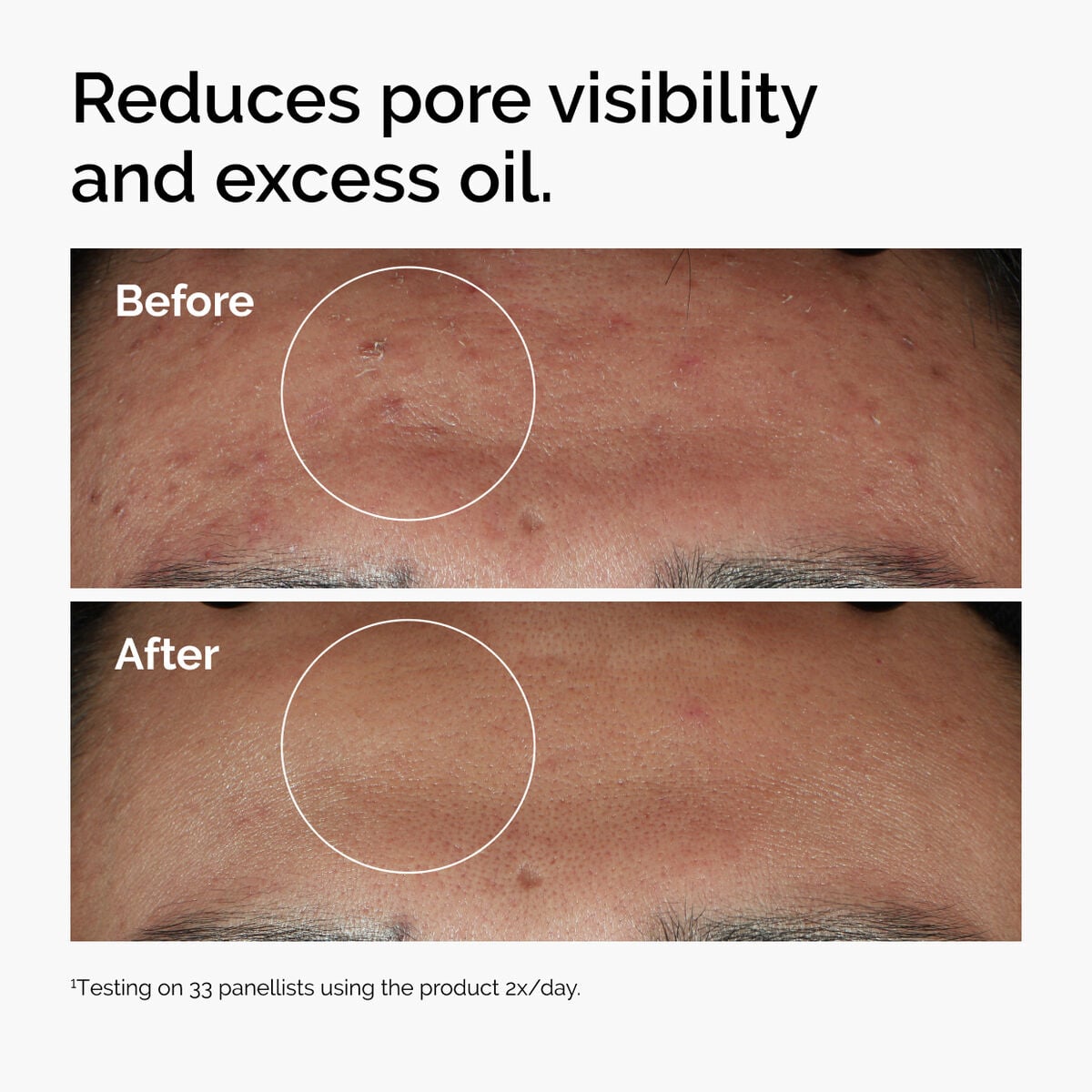 niacinamide-10-zinc-1-e6 ord-niacinamide-zinc-blemish-serum-before-after-pores.jpg