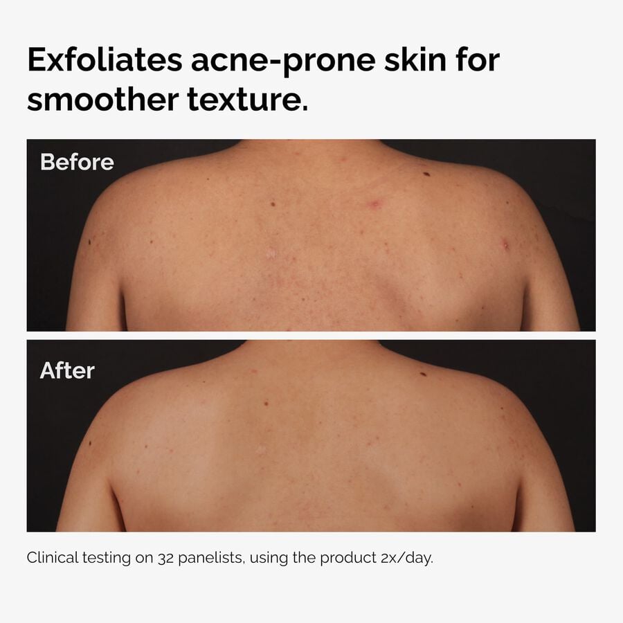 the-body-care-collection-x0 ord-salicylic-acid-body-serum-before-after-graphic-NA.jpg